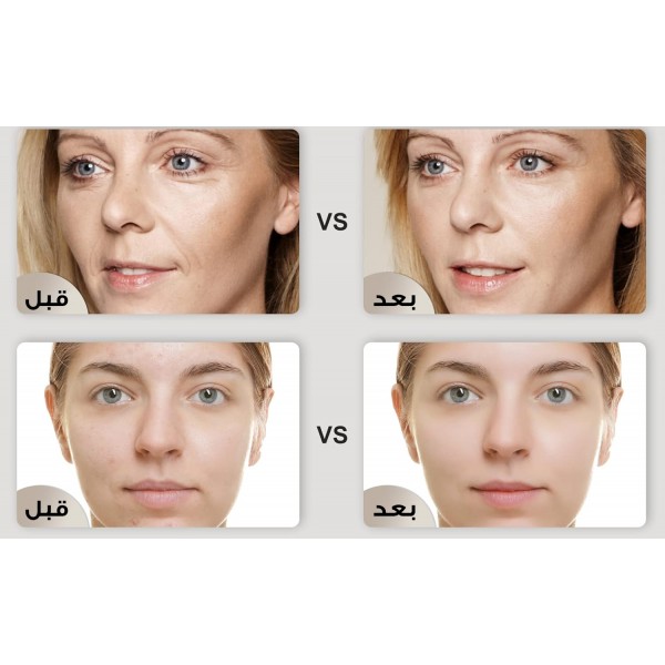 جهاز ليزر  لبشرة زجاجية