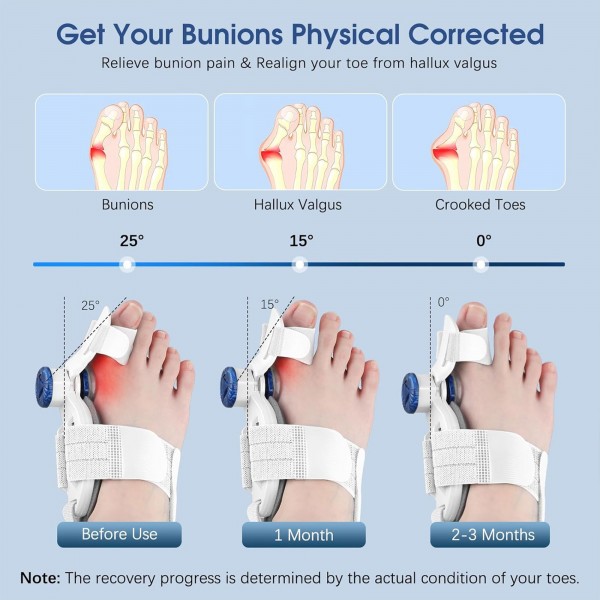 مصحح إبهام القدم القابل للتعديل للنساء والرجال