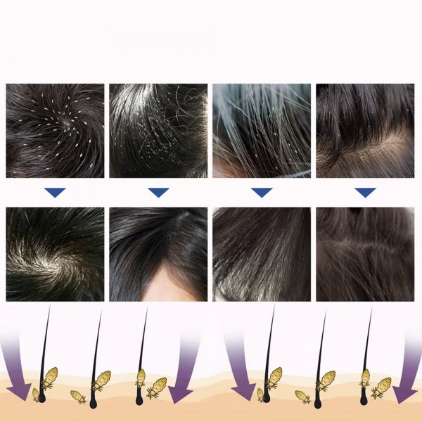 بخاخ علاج فعال للقمل امن للاطفال والكبار