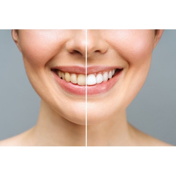 باودر تبيض الاسنان 5Days