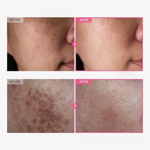 7% أربوتين 4% حمض ترانيكساميك سنتيلا ريتينول كريم للوجه متعدد الاستخدامات