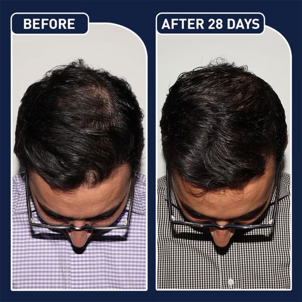 عرض 2  FEG Plus لنمو الشعر